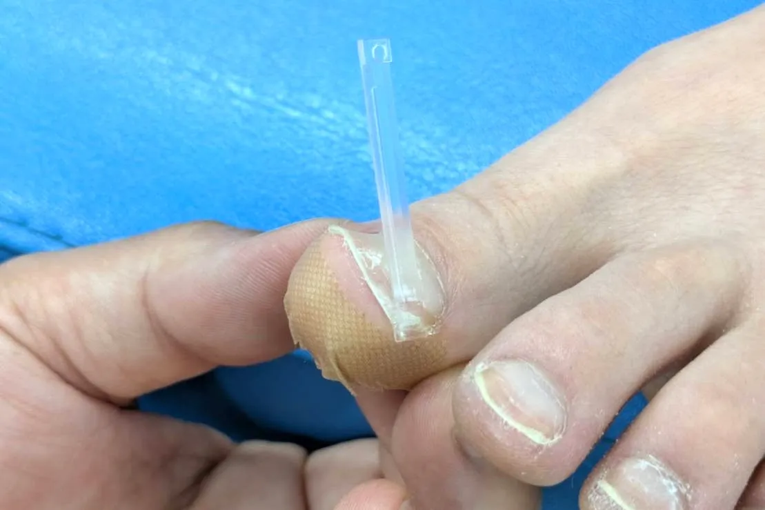 痛みの少ない補整器具の装着のイメージ